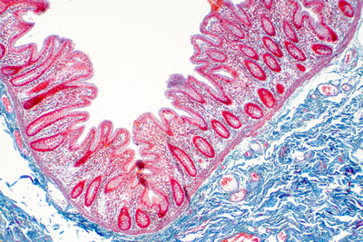 Sindromul intestinului permeabil: cauze, simptome și remedii