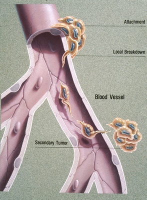 Anti-angiogeneza: o modalitate naturală și eficientă de a preveni cancerul și obezitatea Anti-angiogeneza: o modalitate naturală și eficientă de a preveni cancerul și obezitatea